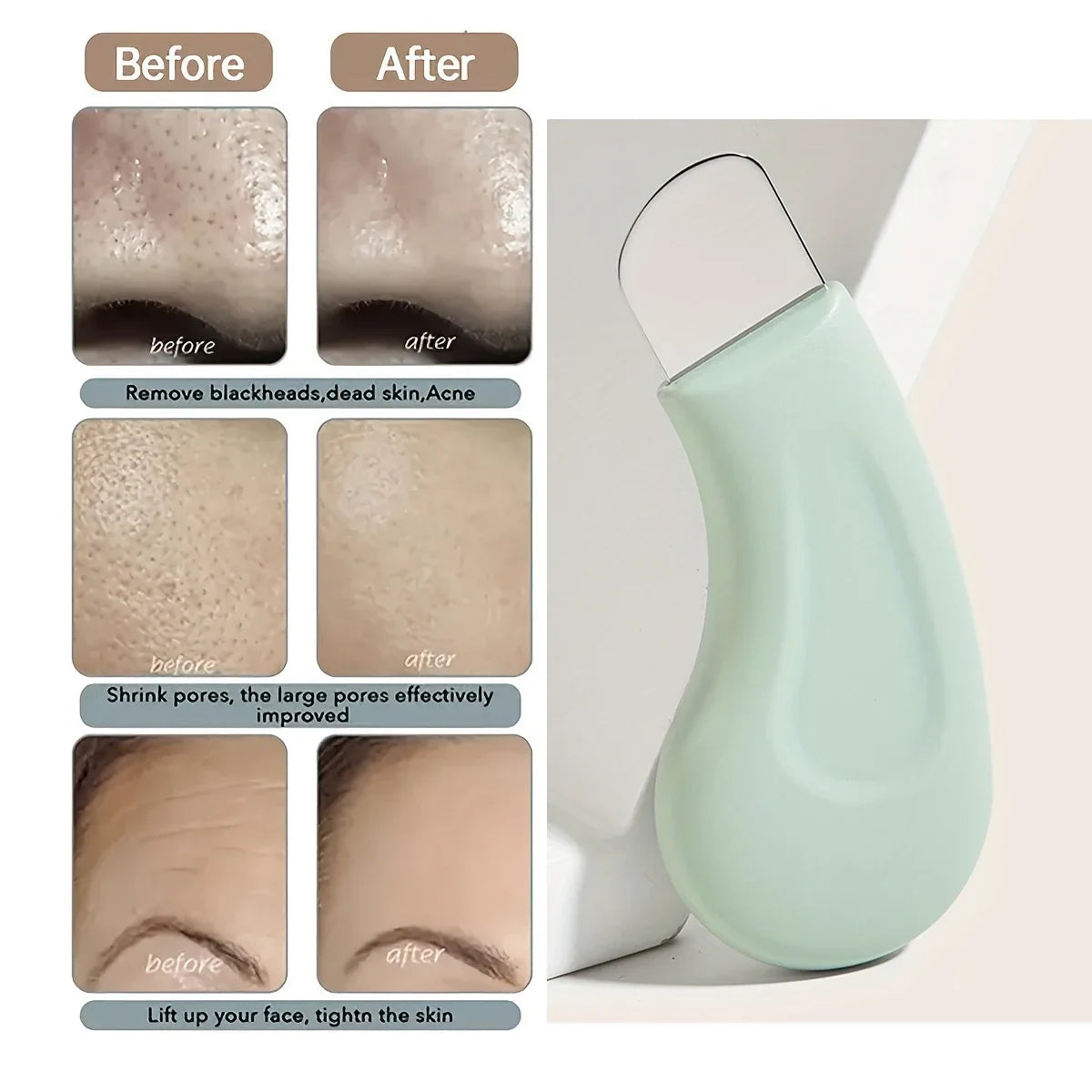 Blackhead and whitehead removal tool, effective for clear skin treatment