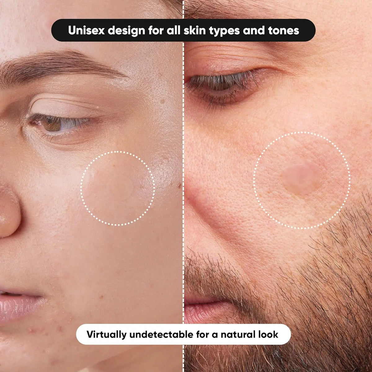 hydrocolloid pimple patch invisible blemish sticker (photo 4 of 10)